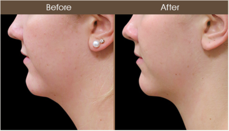 Laser Neck Lift Surgery Results